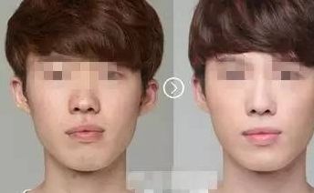 北京哪家眼整形醫(yī)院雙眼皮效果好？