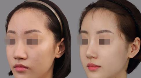 國內(nèi)哪些醫(yī)院提供5G天使光雕治療？價格及官方認(rèn)證醫(yī)院分享