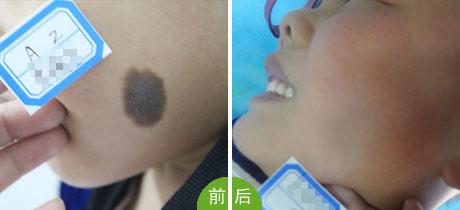 成都自體隆鼻專家推薦！2023年TOP10強(qiáng)成都整容醫(yī)院等你來挑選！