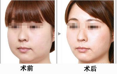 杭州Botox除皺針去皺整形醫(yī)院推薦！2023年TOP10醫(yī)院排行榜公布，網(wǎng)友一致推崇！