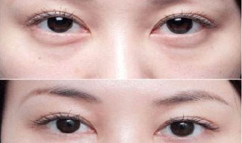 武漢亞韓整形醫(yī)院射頻美容治療費(fèi)用高昂？突出特色你了解嗎？