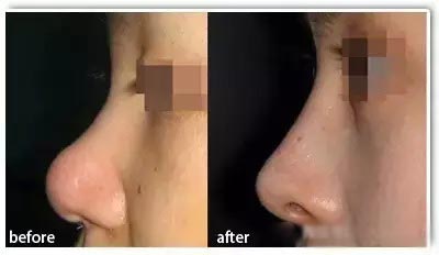 重慶熱拉提去動態(tài)細紋10家整形醫(yī)院推薦，讓你煥發(fā)青春美麗！