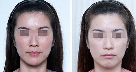 溫州哪家醫(yī)院的電波拉皮治療眼袋效果好？2023年前10名醫(yī)院曝光！