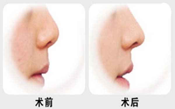 天津微雕去除動態(tài)細紋整形美容醫(yī)院排行榜揭曉！2023年權(quán)威推薦的前十家醫(yī)院大揭秘！