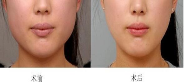 廣州乳房整形醫(yī)院哪家最受歡迎？大醫(yī)院與私立之爭(zhēng)排行前十！