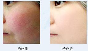 2023年昆明眼周紋肉毒素注射整形美容醫(yī)院排名推薦