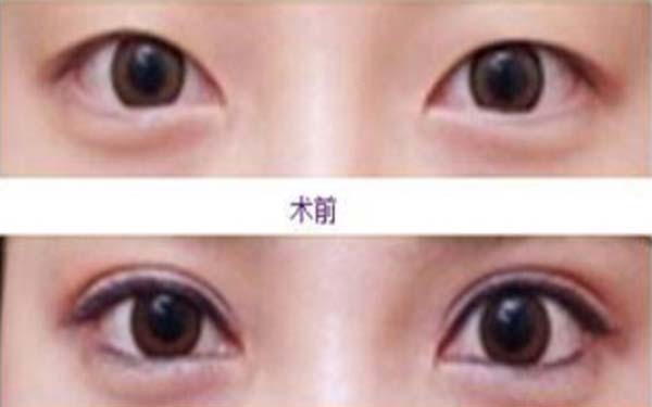 寧波哪家醫(yī)療美容醫(yī)院在2023年前10榜單中有名氣，專業(yè)祛除眼角紋的微雕技術(shù)是他們的亮點