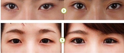 南京眼部細(xì)紋填充玻尿酸醫(yī)院排名前十強(qiáng)揭曉