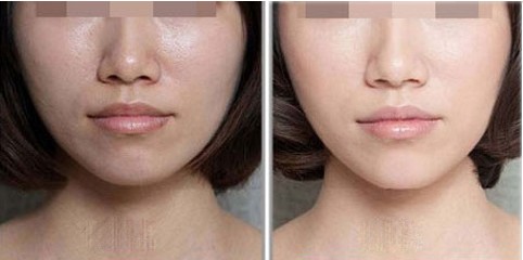 馬鞍山哪家專業(yè)醫(yī)院瘦臉吸脂效果好？排行榜前10強(qiáng)揭曉！