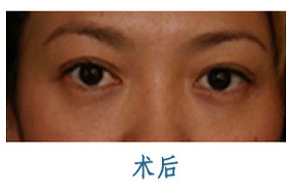 南寧自體脂肪注射眼周紋醫(yī)院十強(qiáng)排名新鮮出爐！