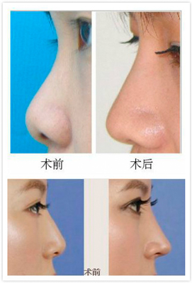 上海注射去紋面部整形醫(yī)院哪里好？2023年上?？诒己玫那笆笳葆t(yī)院推薦！