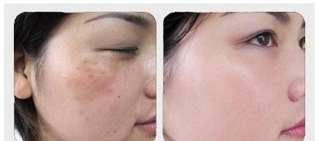 鄭州眼部細(xì)紋秒除，排名前十權(quán)威醫(yī)院揭秘！