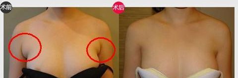 信陽去除背部脂肪 權(quán)威整形醫(yī)院名錄