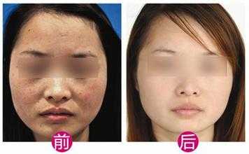 昆明熊貓針填充眼窩效果好的整形醫(yī)院推薦