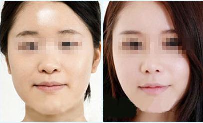 上海哪家醫(yī)院切痣好評(píng)如潮？2023年上海切痣排名前十強(qiáng)邁進(jìn)！