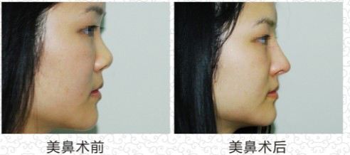 蘭州哪家整形醫(yī)院的激光點陣祛老年斑效果好？