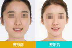 2023年北京乳溝隆胸有經(jīng)驗?zāi)募裔t(yī)院好？排名前十醫(yī)院技術(shù)口碑PK！
