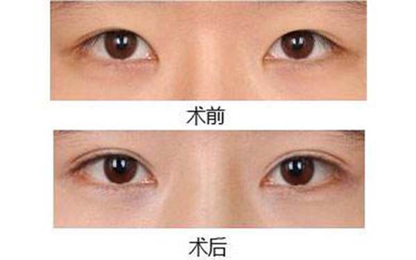云南哪家MISKO4D隆鼻整形醫(yī)院被評(píng)為2023年前10名？