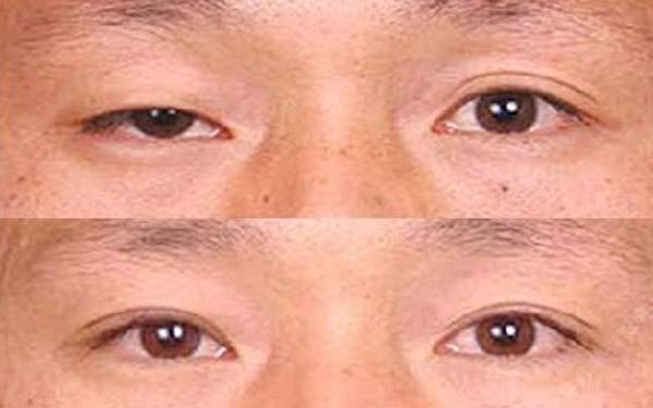 廈門消除眼周紋首選醫(yī)院推薦！2023年十大美容醫(yī)院排行榜出爐，技術(shù)一流！