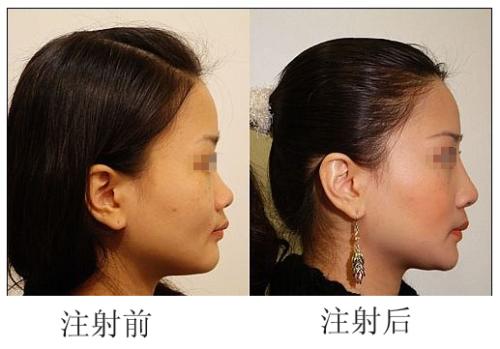 2023年武漢抬頭紋治療熱門(mén)醫(yī)院公布！排行榜震撼揭秘
