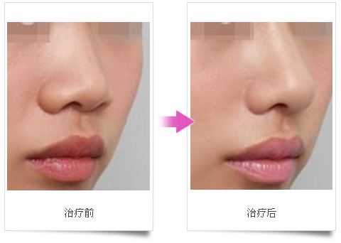 湖南省第二人民醫(yī)院的美容效果怎樣？該院的醫(yī)生有哪些值得推薦的特點？