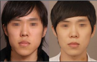 廣州頸部皺紋去除，評價良好的醫(yī)院哪家好？2023廣州頸部皺紋祛除正規(guī)醫(yī)院排行榜TOP10強二度發(fā)布！