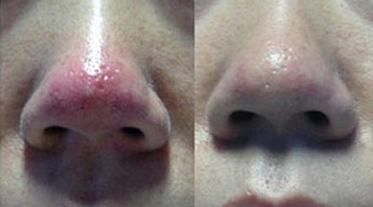 深圳北大醫(yī)院有哪位醫(yī)生擅長玻尿酸隆鼻？