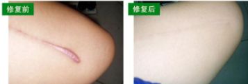 上海疤痕修復(fù)醫(yī)生：排行榜前三強(qiáng)，實(shí)力和口碑大揭秘！