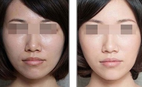 長沙哪家整形美容醫(yī)院的生物注射祛口周紋技術(shù)好？2023年長沙生物注射祛口周紋排行榜前10大醫(yī)院推薦！