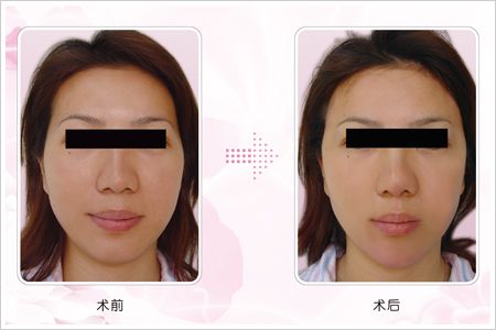 杭州法令紋深層整形醫(yī)院效果好的有哪些？2023年杭州法令紋深層醫(yī)院十佳公認(rèn)的選擇！