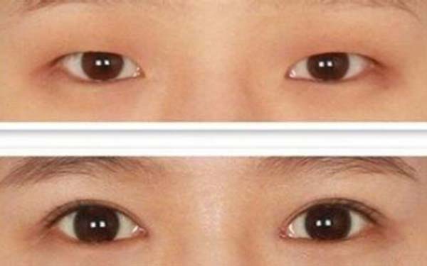 上海比較權威的新生鮮紅斑痣治療醫(yī)院是哪家？2023年上海治療新生鮮紅斑痣醫(yī)療機構排名前十盛行發(fā)布！
