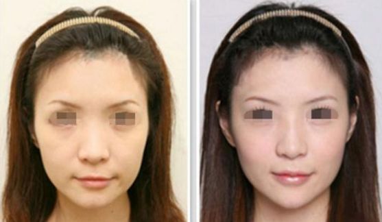 長沙哪家醫(yī)院的雙眼皮整形效果更好？2023最受關(guān)注的醫(yī)院排行榜公布！