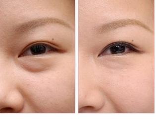 南昌哪家醫(yī)院的熱瑪吉去眼周細(xì)紋效果好？南昌熱瑪吉去眼周細(xì)紋醫(yī)療美容醫(yī)院推薦！