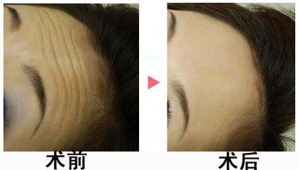 2023天津冷凍治療酒糟鼻醫(yī)院排行榜出爐！這幾家整形效果超贊！