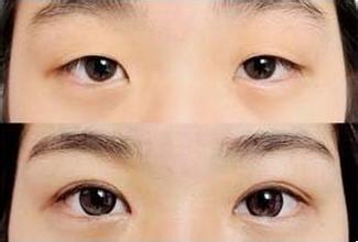 2023淮北哪家光纖溶脂瘦面部醫(yī)院口碑比較好？推薦度高的有哪些？