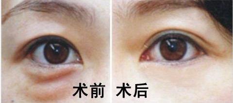 南寧木偶紋去除整形醫(yī)院推薦：口碑優(yōu)選十強榜