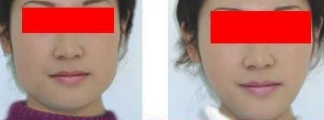 2023年，哪家上海整形醫(yī)院是去除肥胖紋的選擇？線雕技術(shù)為您解決困擾！