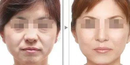 2023年南京有哪些比較有名氣的水光針祛木偶紋整形醫(yī)院？南京水光針祛木偶紋美容醫(yī)院口碑榜TOP10排行榜揭曉