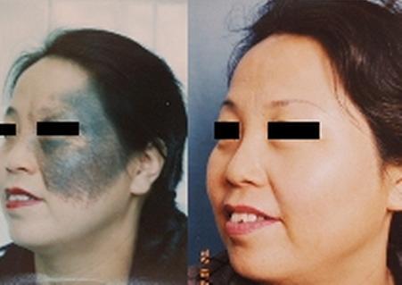 江蘇縮鼻頭整形醫(yī)院推薦！2023年江蘇肉毒桿菌毒素縮鼻頭醫(yī)療美容醫(yī)院排行榜！