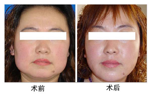 西寧冷凍溶脂瘦小腿：實力醫(yī)院榜單揭曉，一騎絕塵