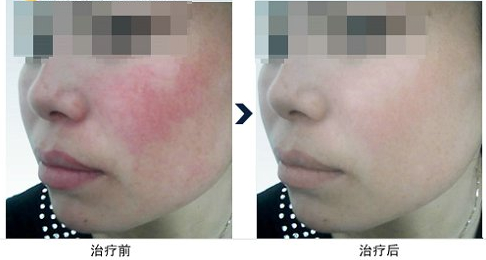 保定最佳射頻祛肥美容醫(yī)院排名TOP10，快速消除肥胖紋！