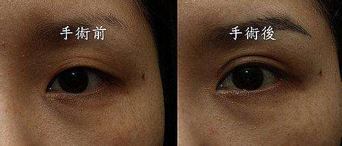 深圳魚尾紋微整形醫(yī)療美容醫(yī)院排行榜2023年非常受歡迎的10家正規(guī)整形醫(yī)院！