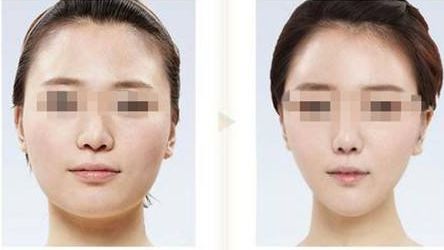 長春那家醫(yī)院做雙眼皮整形好？醫(yī)生實力見證！