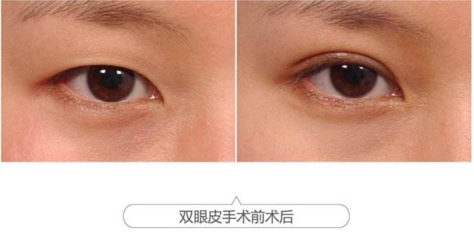 2023年南京哪家醫(yī)院能有效去除肥胖紋？