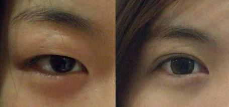 長春眼角紋去除好的整形美容醫(yī)院有哪些？2023長春的膠原蛋白祛眼角紋整容醫(yī)院前十強實力調(diào)查！
