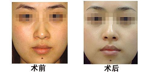 湖南鼻部填充嗨體：摯彩醫(yī)療整形院治療領(lǐng)先，性價比超高！2023湖南鼻部填充嗨體口碑前十名單出爐！