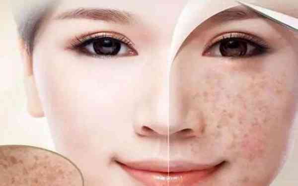 揚(yáng)州哪家醫(yī)院能夠有效去除木偶紋？