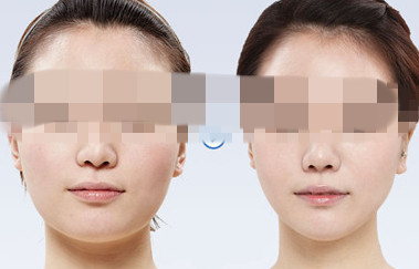 西安激光去除靜態(tài)紋，哪家美容醫(yī)院性價(jià)比比較高？2023年西安激光去除靜態(tài)紋前10強(qiáng)醫(yī)院盤點(diǎn)！