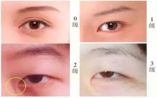 廈門哪家醫(yī)院填充生長紋效果好？據(jù)2023最新榜單，頸部皺紋專業(yè)醫(yī)院推薦！