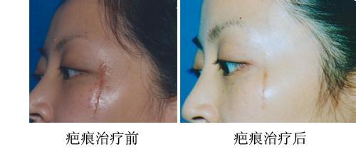 常德市哪家醫(yī)院是正規(guī)的無針精雕鼻子整形醫(yī)院？2023年前10家常德無針精雕鼻子整形醫(yī)院排行榜，這幾家靠前的